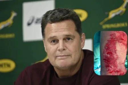 Rassie Erasmus Shares Shocking Images of Chemical Burns